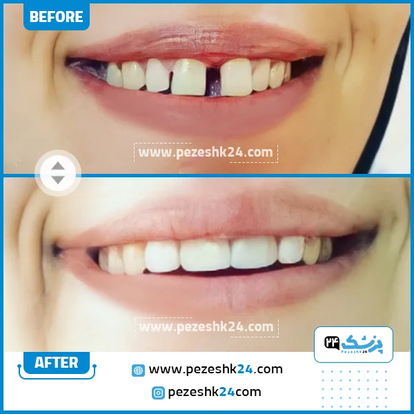 قبل و بعد کامپوزیت دندان دکتر عباس نیا