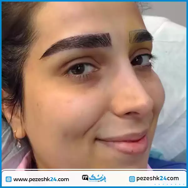 کاشت کل ابرو در کلینیک آریان