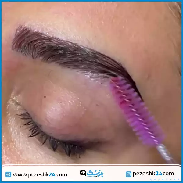 کاشت کل ابرو در کلینیک آریان شیراز