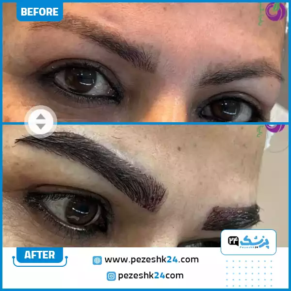 کاشت ابرو تتو شده در کلینیک آریان