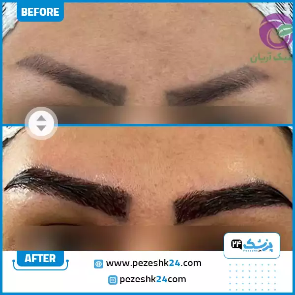 کاشت ابرو تتو شده در کلینیک آریان شیراز