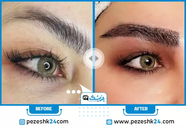 کاشت کل ابرو در کلینیک دنا