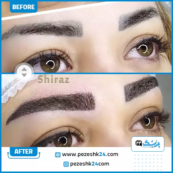 کاشت ابرو روی تاتو کلینیک دنا
