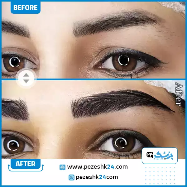 قبل و بعد کل کاشت ابرو در کلینیک دنا