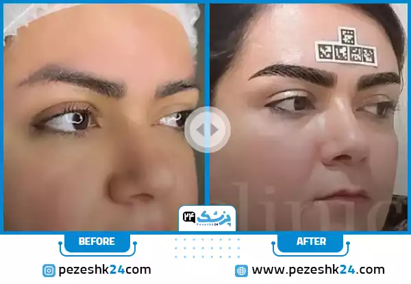 کاشت ابروی نازک در کلینیک دنا