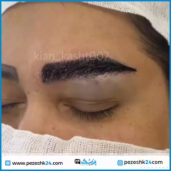 قبل و بعد جراحی کاشت ابرو کلینیک کیان کاشت شیراز