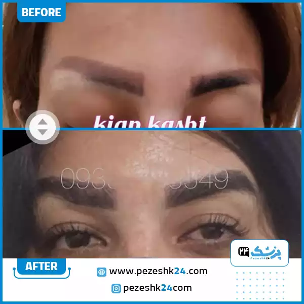 کاشت کل ابرو در کلینیک کیان کاشت