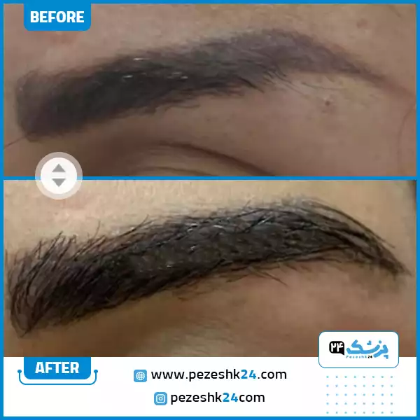 کاشت پایین ابرو در کلینیک کیان کاشت