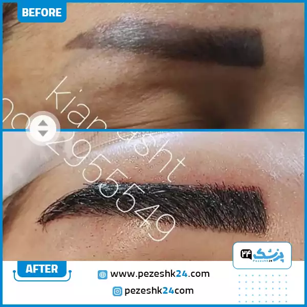 قبل و بعد کاشت ابرو کلینیک کیان کاشت شیراز