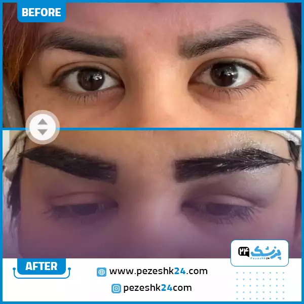 کاشت دو ابرو در کلینیک لیان