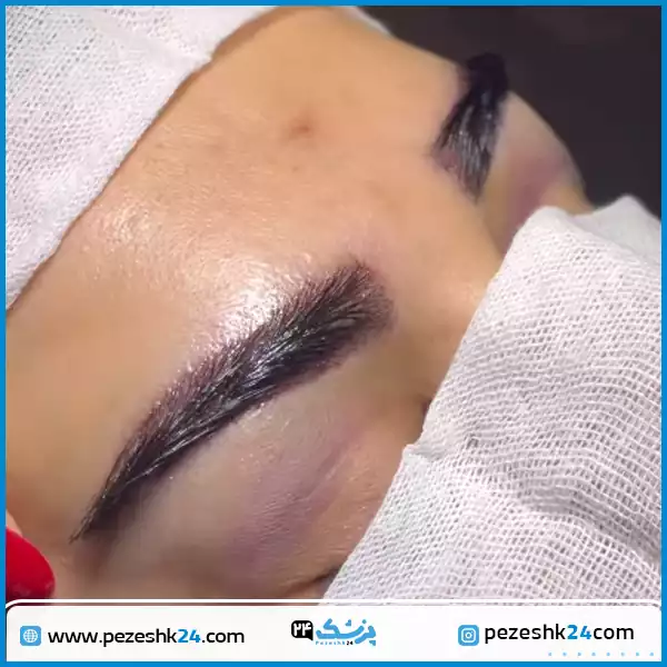 نمونه کاشت دو ابرو در کلینیک لیان