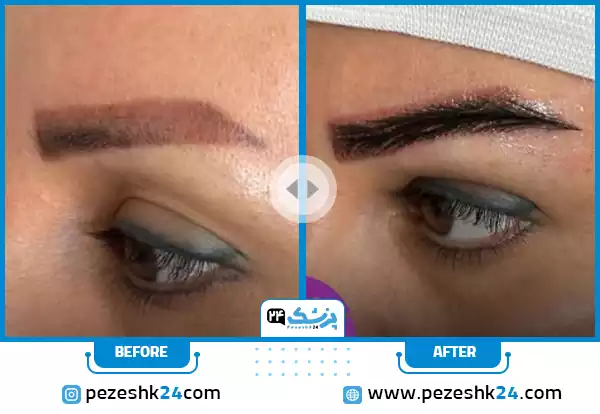 کاشت رو ابروی تتو شده در کلینیک لیان