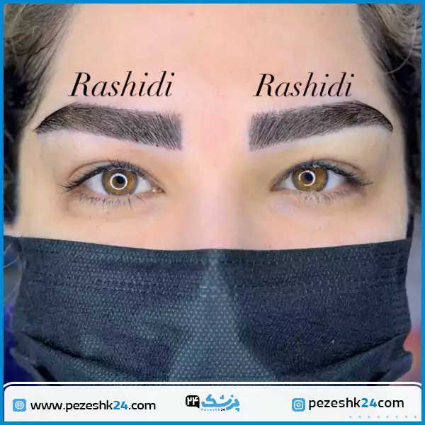 نمونه کاشت ابرو مجموعه رشیدی در شیراز