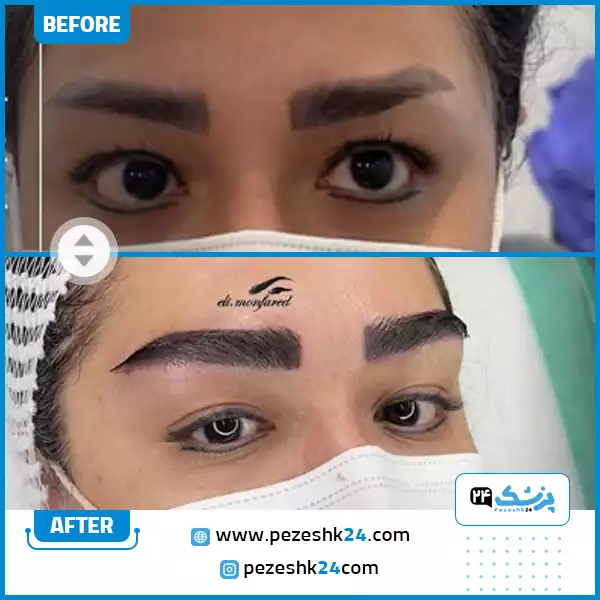 نمونه کاشت ابرو در کلینیک دکتر الی منفرد شیراز