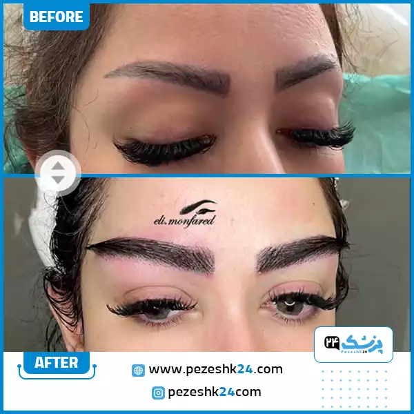 جراحی کاشت ابرو در کلینیک دکتر الی منفرد شیراز