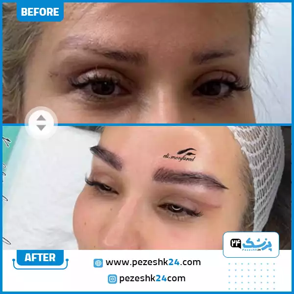 جراحی کاشت ابرو در کلینیک دکتر الی منفرد