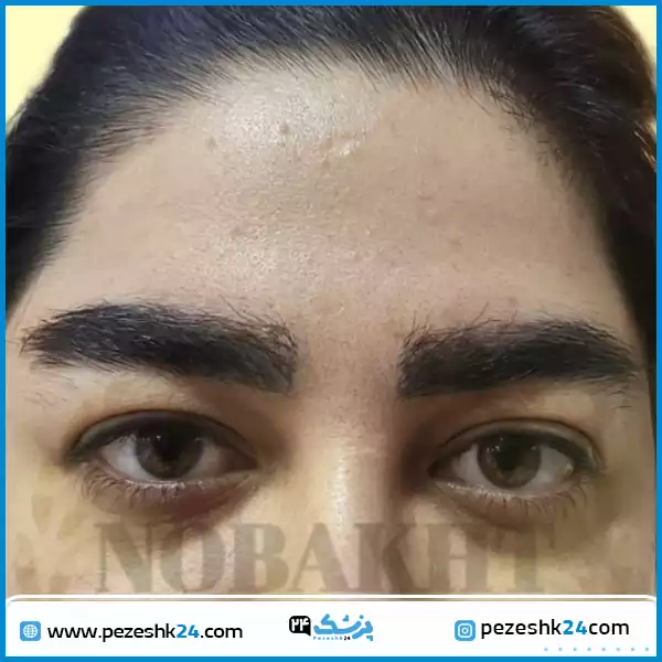 کاشت مدل پر ابرو در کلینیک دکتر نوبخت