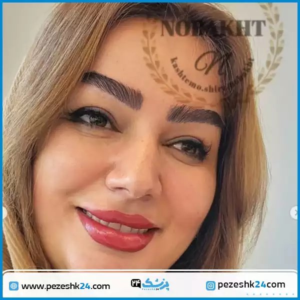 نمونه جراحی کاشت ابرو کلینیک دکتر نوبخت شیراز