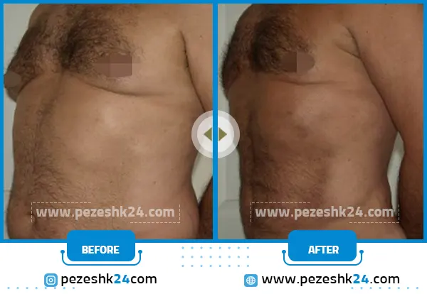 قبل و بعد لیپوماتیک شکم تهران