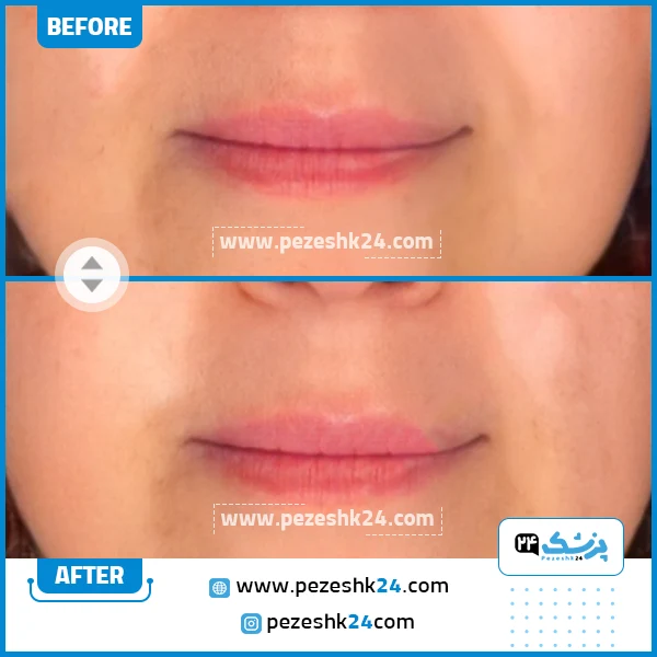 قبل و بعد هایفوتراپی کلینیک ریتا