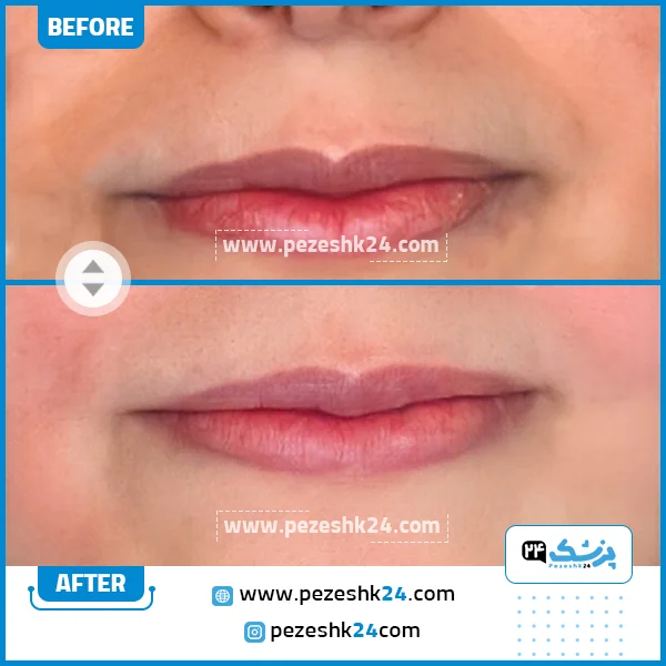 قبل و بعد هایفوتراپی کلینیک ریتا تهران