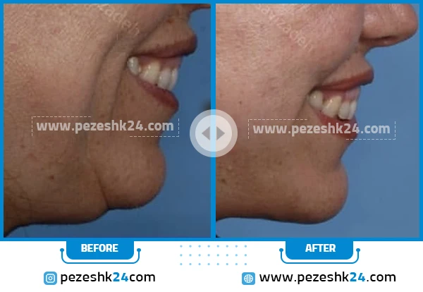 قبل و بعد از جراحی غبغب دکتر موسوی زاده