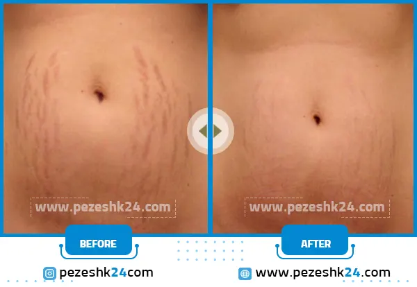 قبل و بعد از بین بردن ترک پوستی