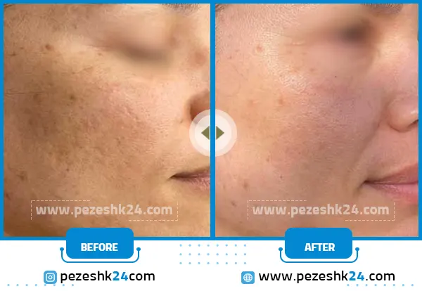 میکرونیدلینگ جای جوش