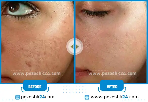 قبل و بعد از میکرونیدلینگ صورت