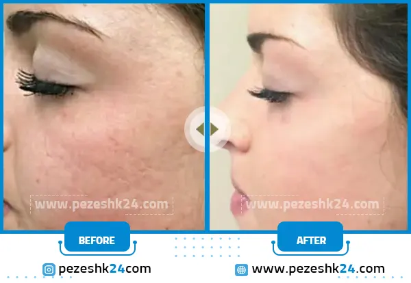 میکرونیدلینگ صورت