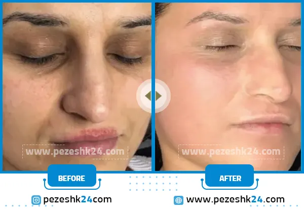 میکرونیدلینگ صورت در تهران