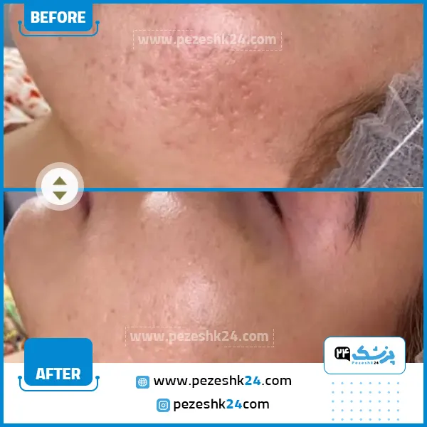 میکرونیدلینگ زیر چشم