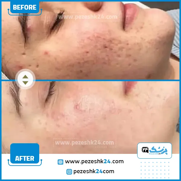 بهترین دستگاه میکرونیدلینگ