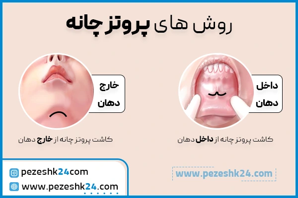 روش های جراحی پروتز چانه