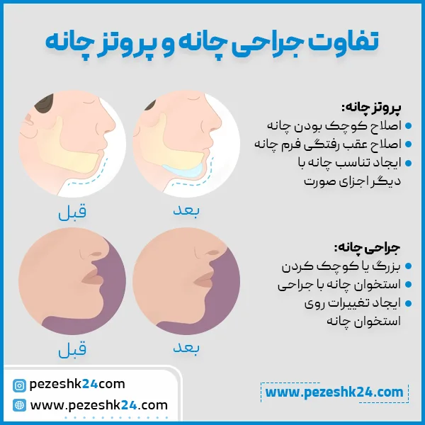 تفاوت جراحی چانه با پروتز
