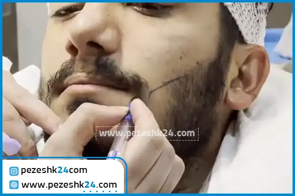 کاشت ریش کلینیک تهران نوین