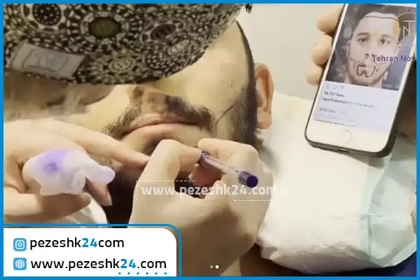 کاشت ریش مرکز تهران نوین