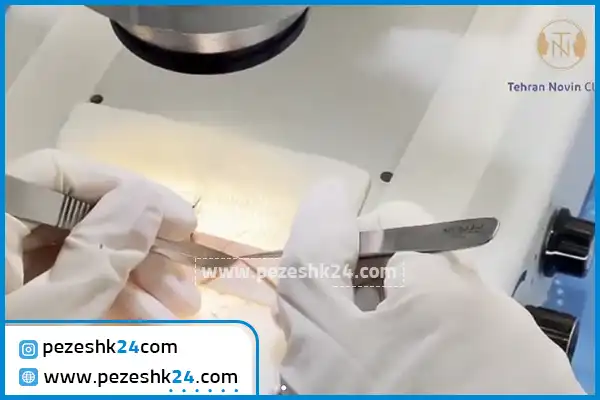 کاشت ریش و سبیل کلینیک تهران نوین