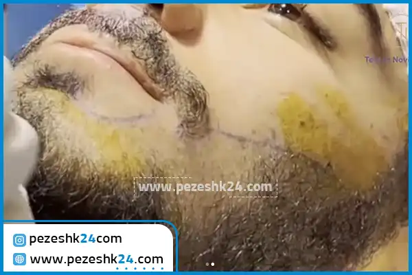 کاشت ریش کلینیک تخصصی تهران نوین