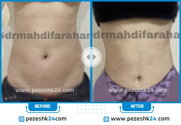 قبل و بعد جراحی لیپوساکشن دکتر فراهانی تهران