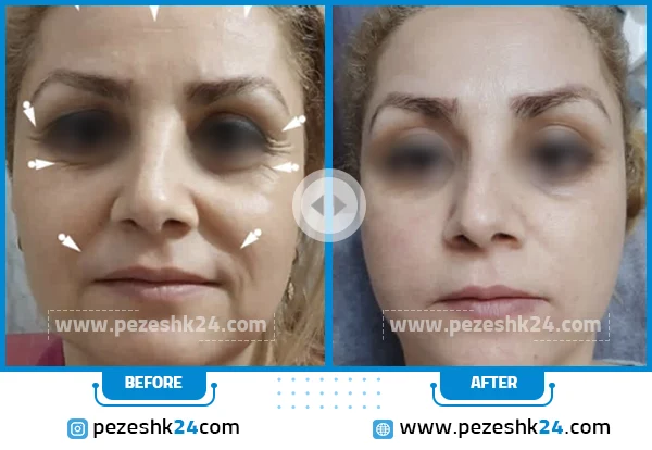 قبل و بعد هایفوتراپی کلینیک آوینا