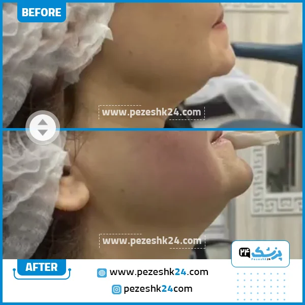 قبل و بعد از هایفو کلینیک آوینا