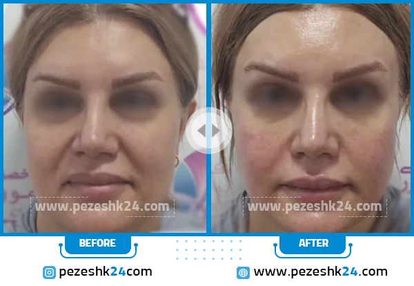 قبل و بعد از هایفوتراپی آوینا تهران