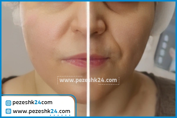 قبل و بعد هایفوتراپی کلینیک بلانژ