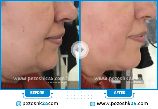 قبل و بعد هایفوتراپی کلینیک بلانژ