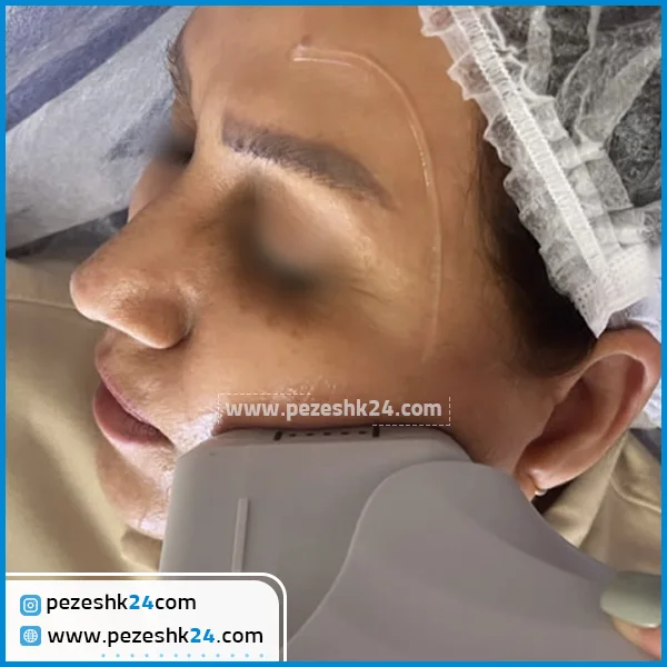 قبل و بعد از هایفو در کلینیک دلدار