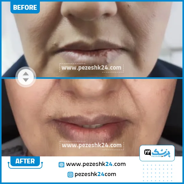 قبل و بعد هایفو کلینیک دلدار تهران