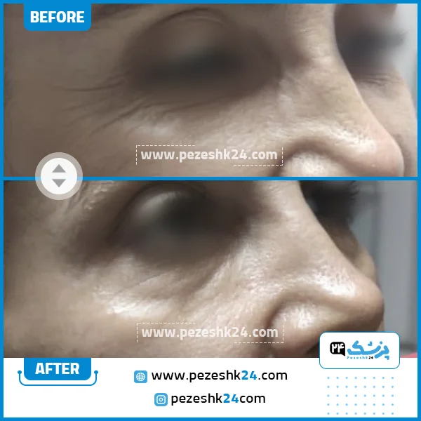 قبل و بعد از هایفو کلینیک دلدار