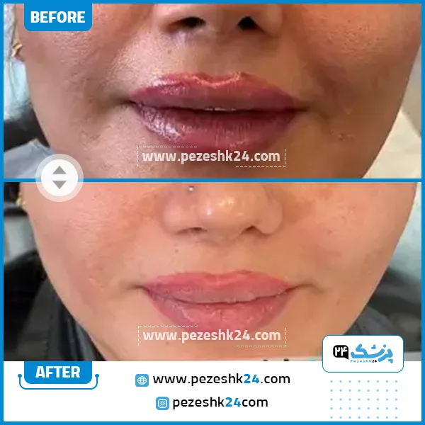 قبل و بعد هایفوتراپی کلینیک الیزه تهران