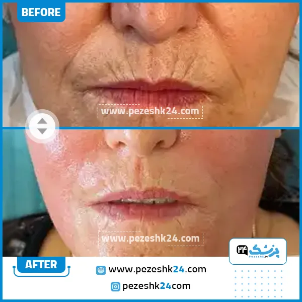 قبل و بعد هایفوتراپی کلینیک الیزه